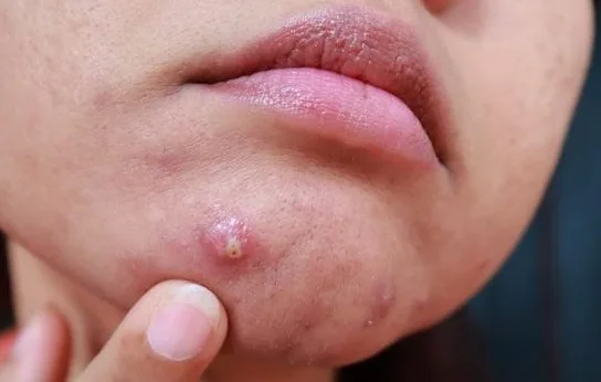 6 Penyebab Jerawat di Dagu Akibat Hormon dan Cara