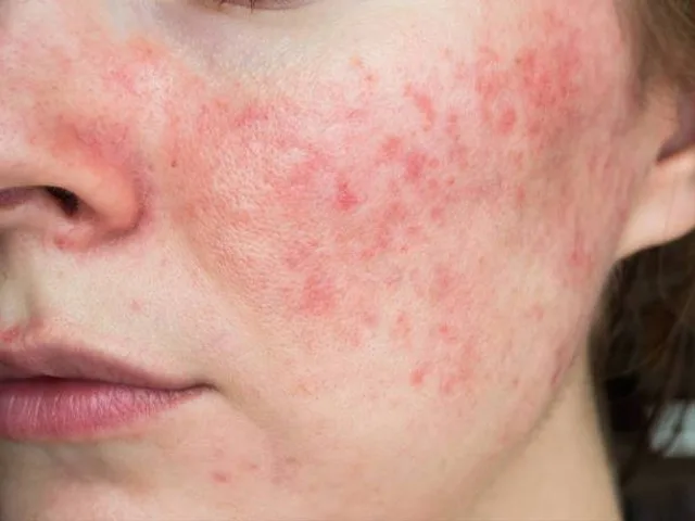 7 Tanda Skin Barrier Rusak dan Cara Mengatasinya Secara