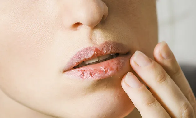 penyebab bibir kering dan pecah