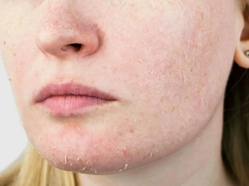 skin barrier rusak - Cara Memperbaiki Skin Barrier dengan Pendekatan Alami