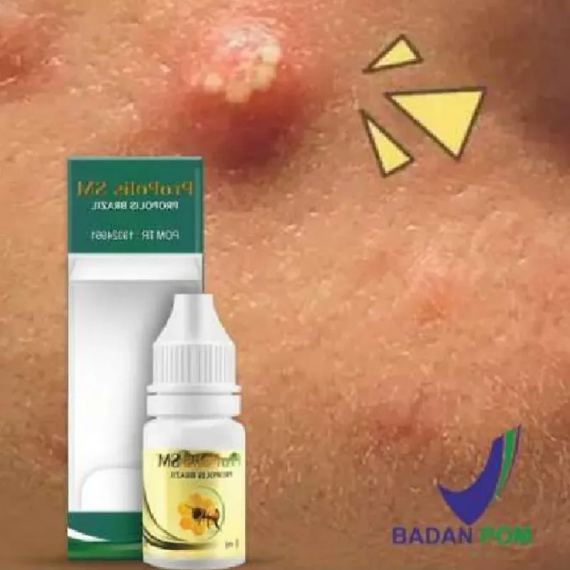 obat jerawat batu - Kenali Dulu Penyebab Jerawat Batu sebelum Memilih Obat