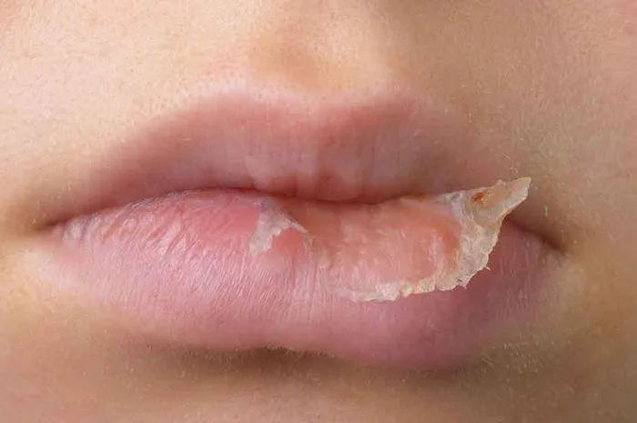 penyebab bibir kering dan pecah: Langkah Praktis Mengatasi Bibir Kering dan Pecah-Pecah