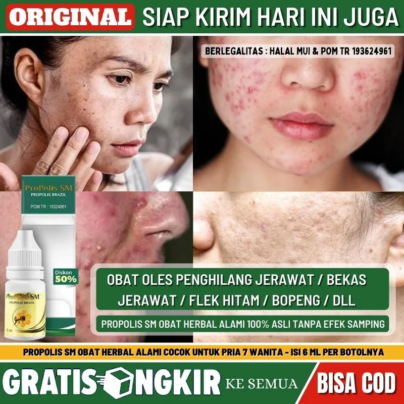 obat jerawat batu - Perbandingan Jenis Pengobatan Jerawat Batu