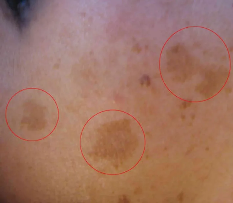 Kedudukan Flek Coklat sebelum Haid dalam Fiqh Wanita
