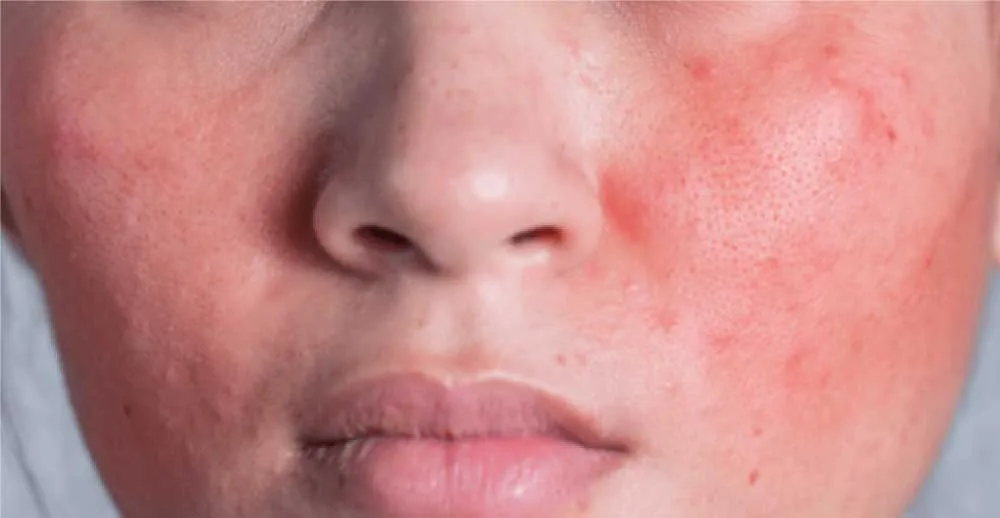 Berapa Lama Skin Barrier Rusak Membutuhkan Waktu untuk