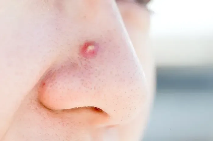 Cara Mengempeskan Jerawat di Hidung Secara Cepat dan Aman