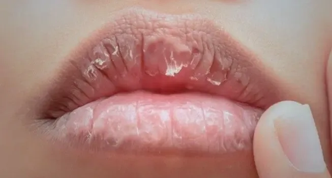 penyebab bibir kering dan pecah