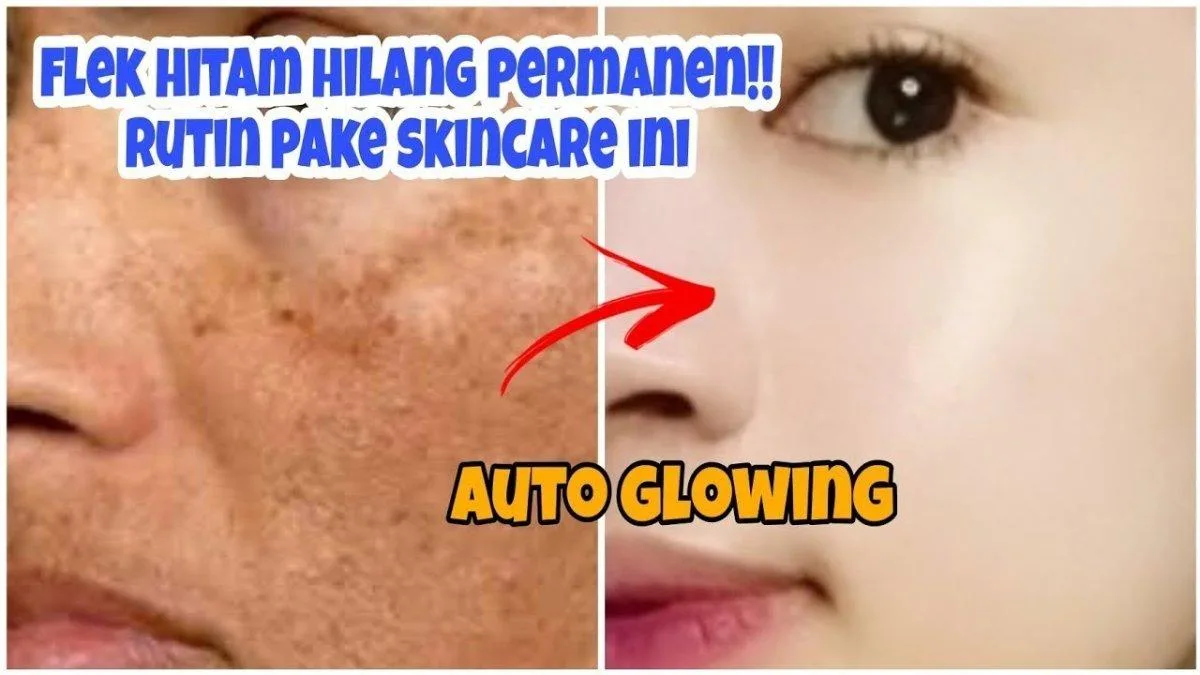 menghilangkan flek hitam di wajah