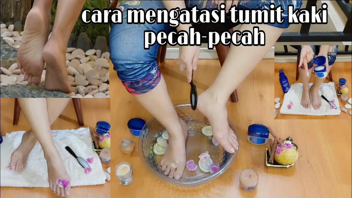 mengatasi tumit kaki pecah pecah: Kriteria Tumit Sehat yang Perlu Anda Ketahui