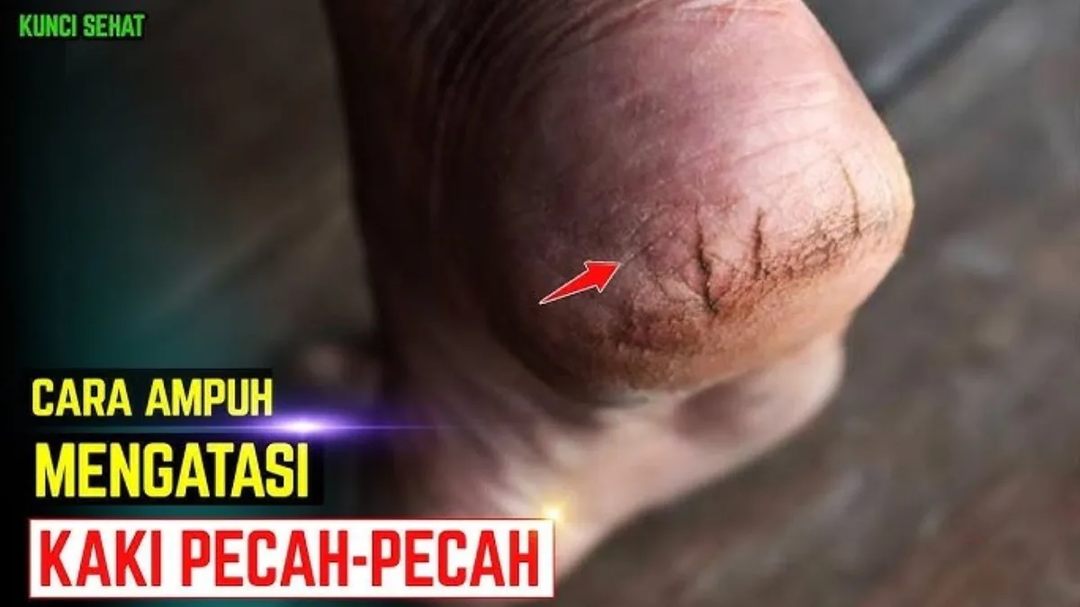 mengatasi tumit kaki pecah pecah