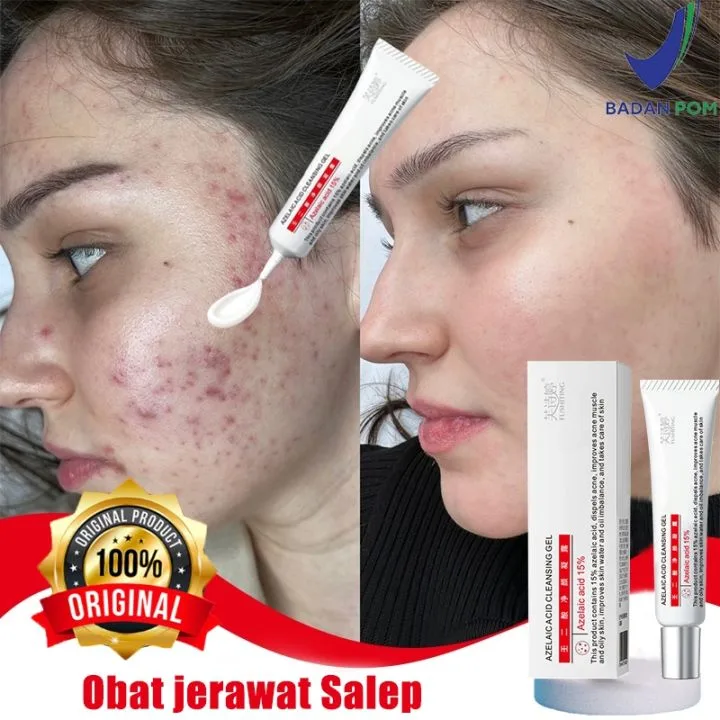 obat jerawat batu