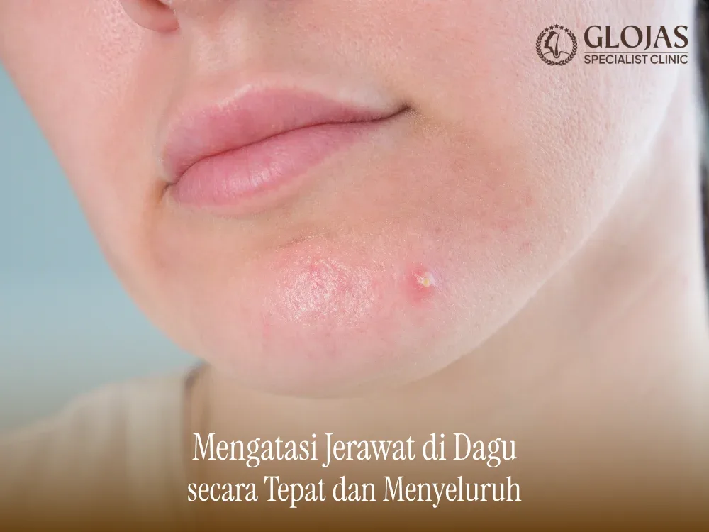 Kebiasaan Harian yang Membantu Mencegah Jerawat di Dagu