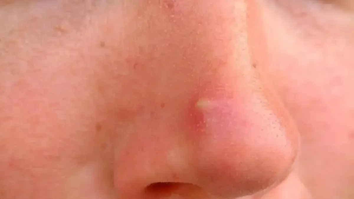 jerawat di hidung