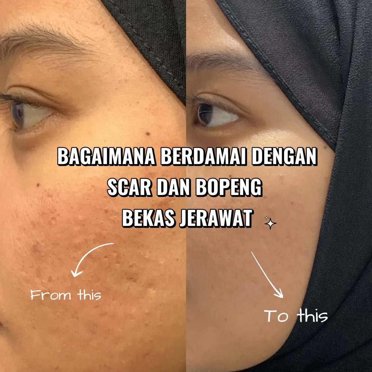 bopeng bekas jerawat