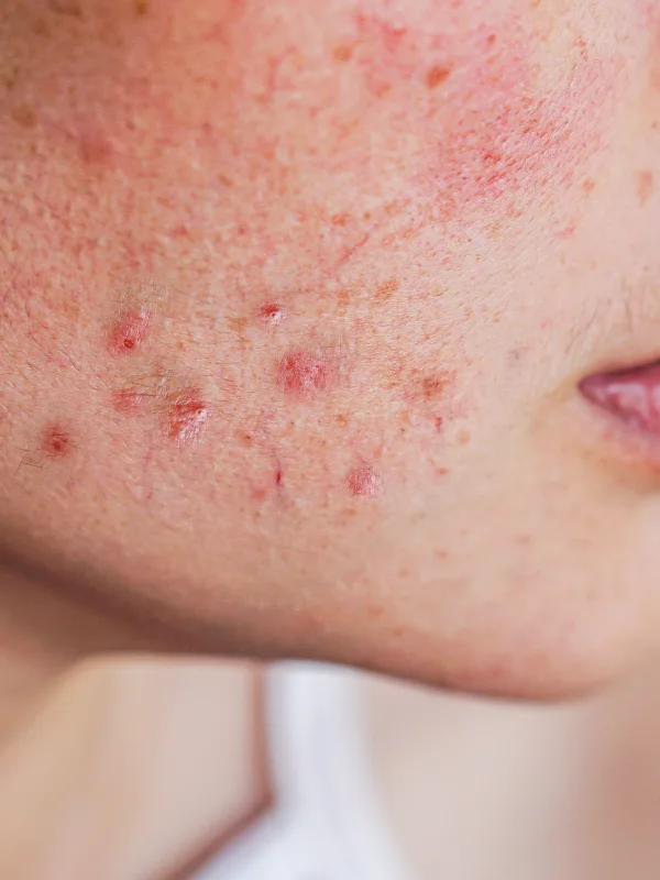 Menyusun Rutinitas Skincare untuk Bekas Jerawat Kemerahan