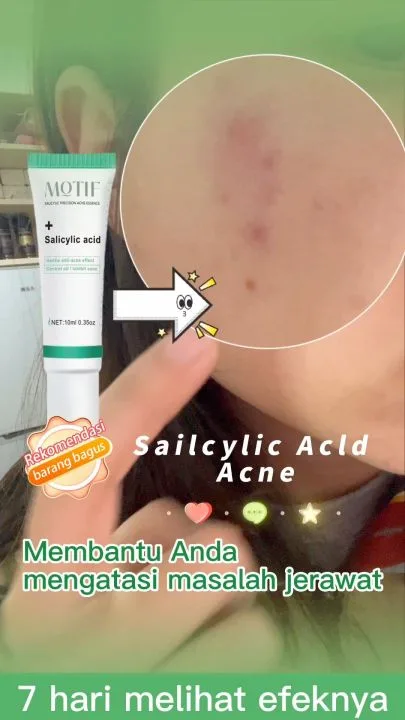 Efek Samping dan Batasan Salicylic Acid untuk Jerawat yang