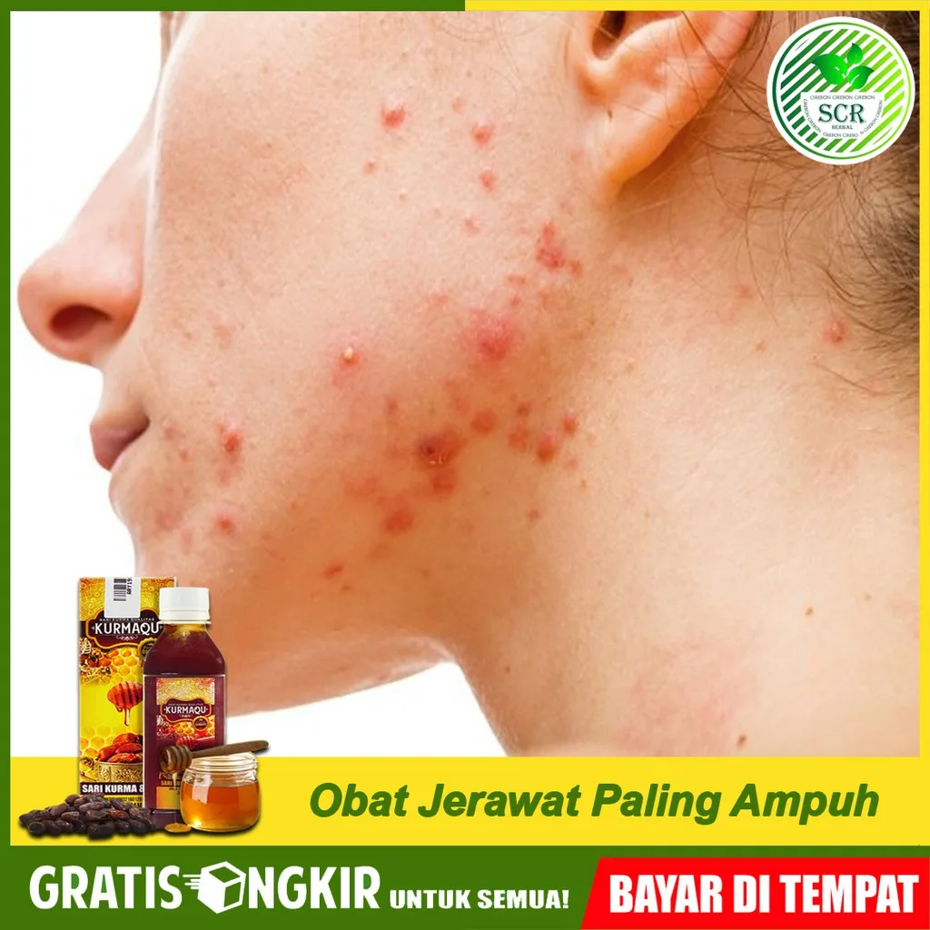 obat jerawat batu: Kesalahan yang Sering Dilakukan saat Mengatasi Jerawat Batu