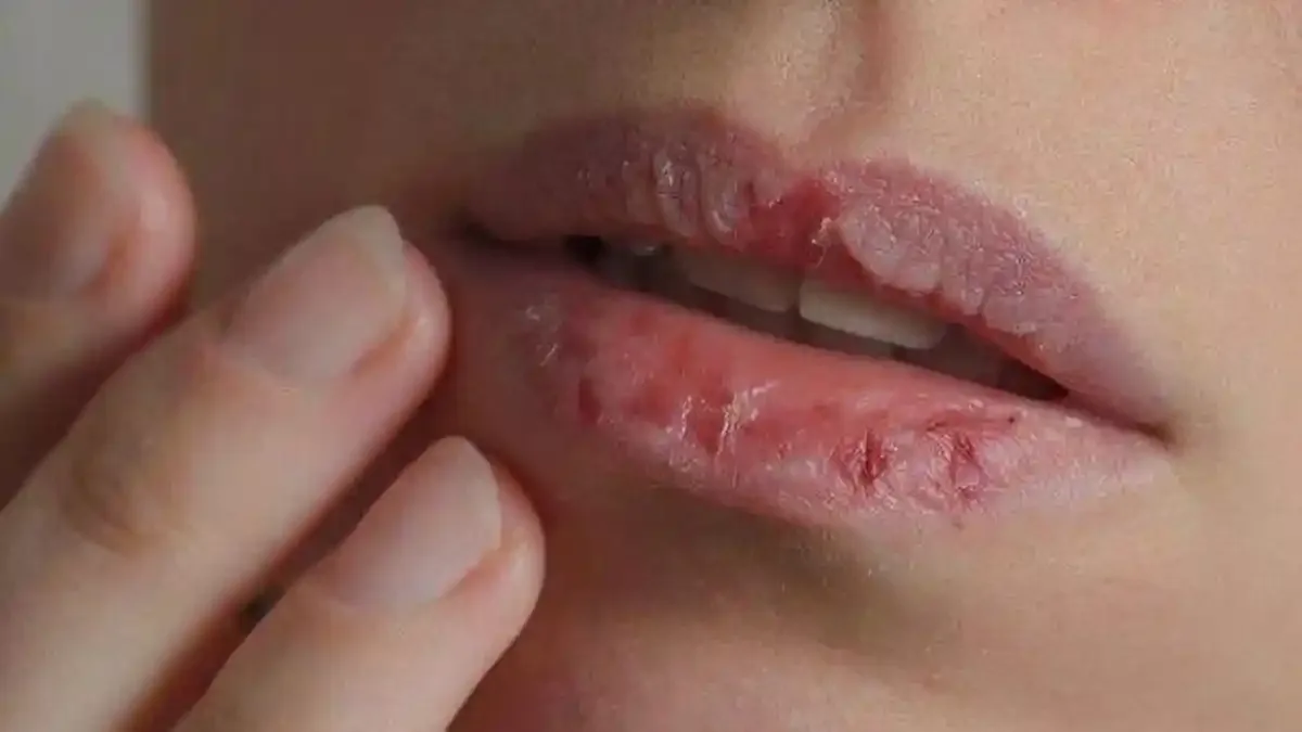 penyebab bibir kering dan pecah