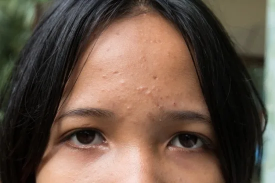 jerawat di dahi