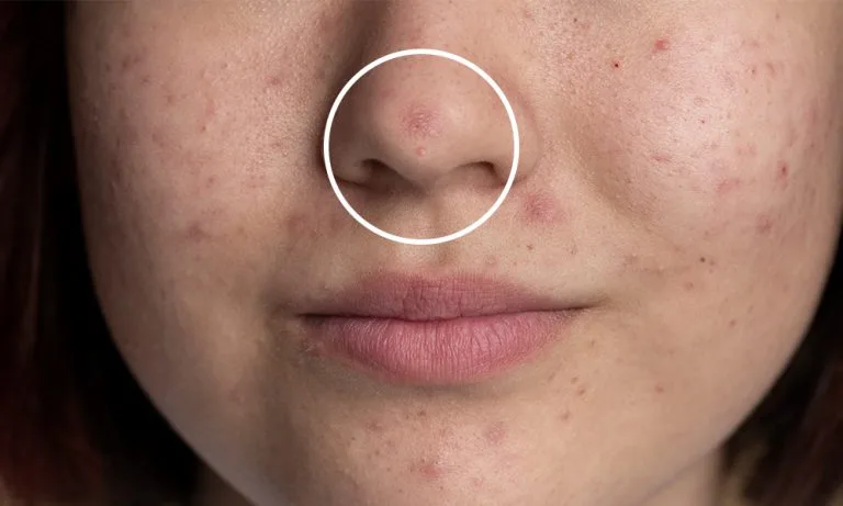 jerawat di hidung
