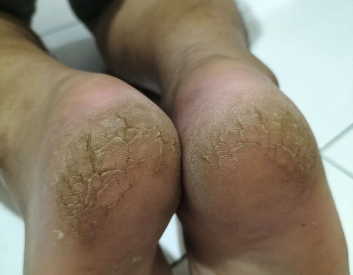 Rangkuman dari Lima Cara Mengatasi Tumit Kaki Pecah Pecah