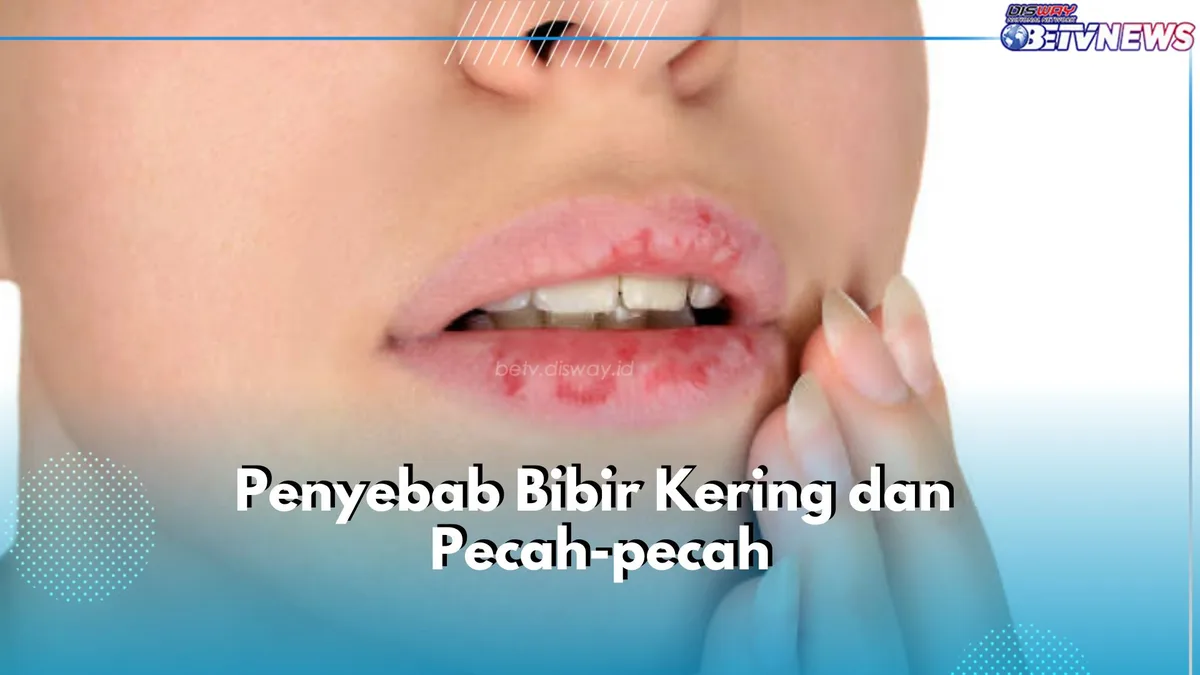 penyebab bibir kering dan pecah: Cara Menyembuhkan Bibir Pecah yang Sudah Terlanjur Luka