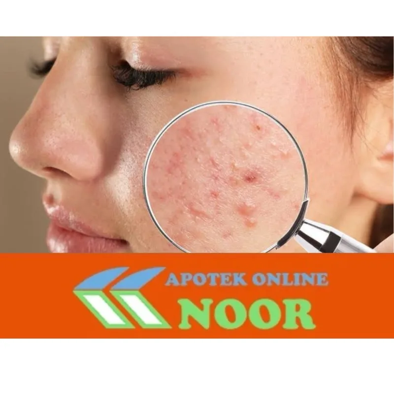 obat jerawat batu