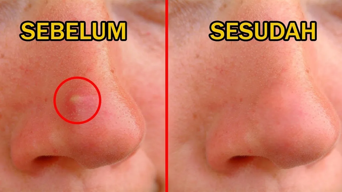 5 Cara Mengatasi Jerawat di Hidung tanpa Bekas