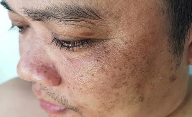 menghilangkan flek hitam di wajah