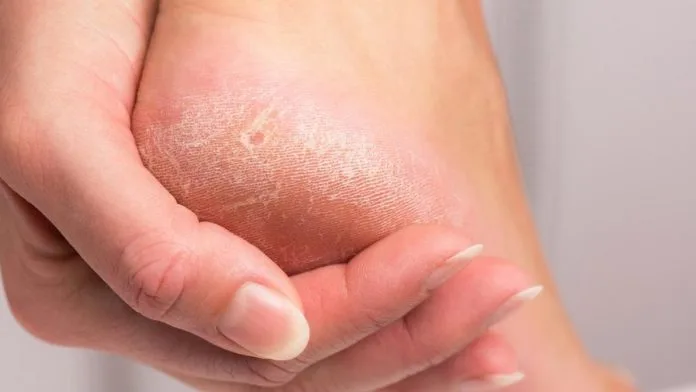 mengatasi tumit kaki pecah pecah: Cara Pertama: Menghidrasi Kulit dengan Pelembab Tumit Kaki