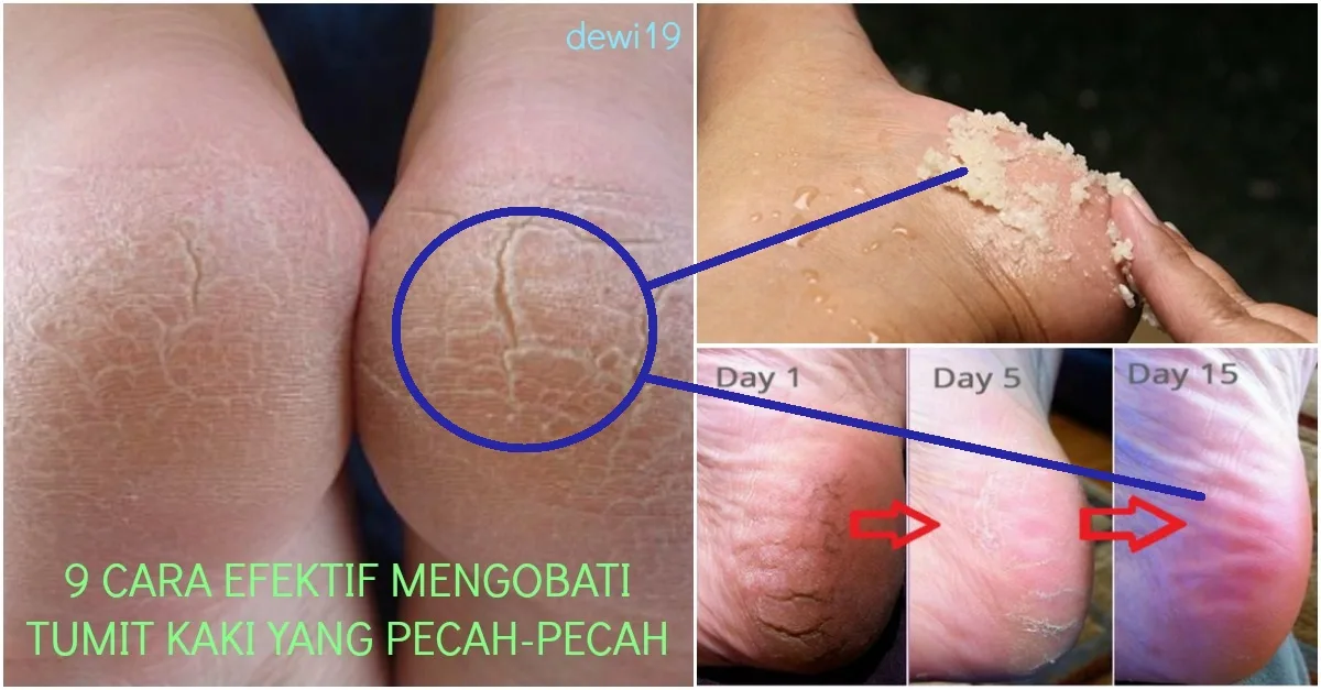 mengatasi tumit kaki pecah pecah: Kesalahan yang Sering Terjadi saat Mengatasi Tumit Kaki