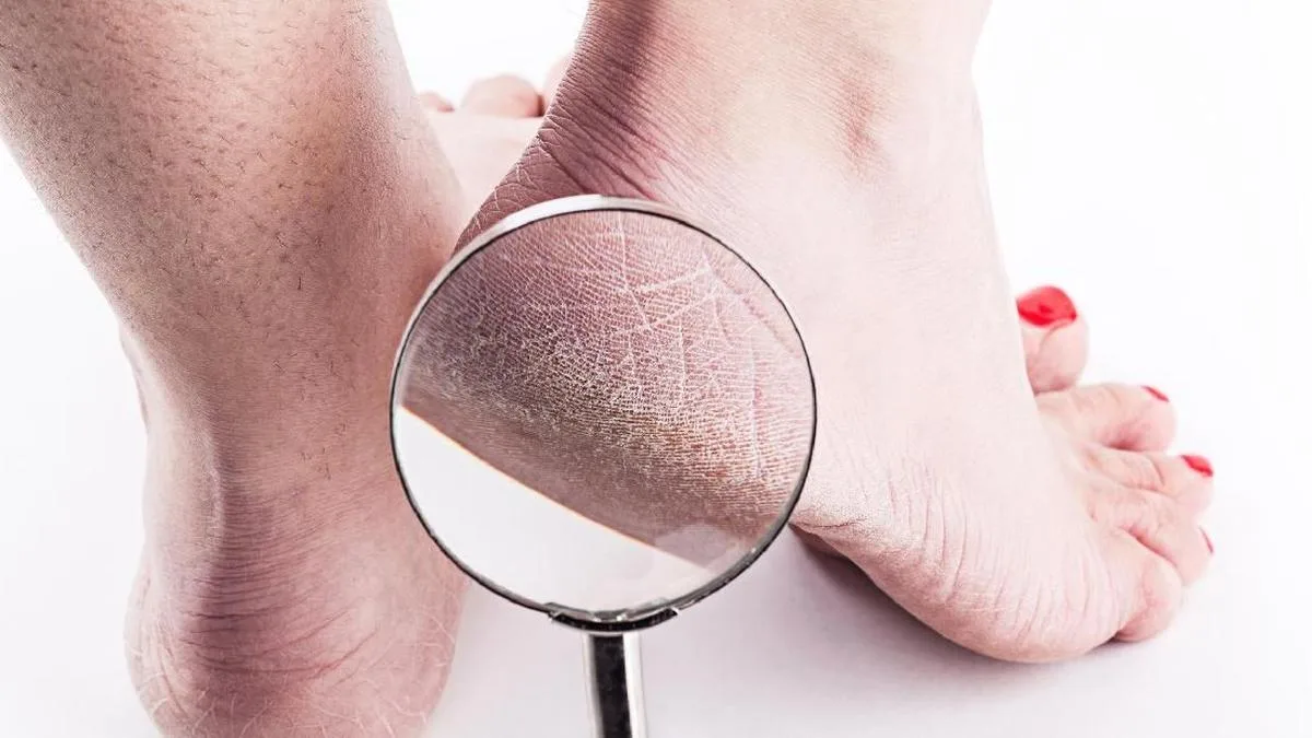 mengatasi tumit kaki pecah pecah
