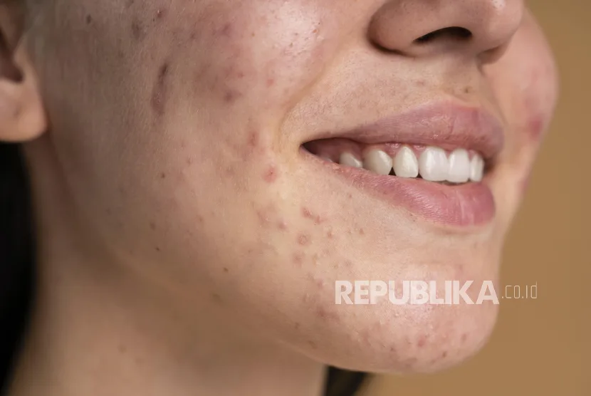 jerawat di dagu - Cara Mengatasi Jerawat Hormonal di Dagu Secara Tuntas