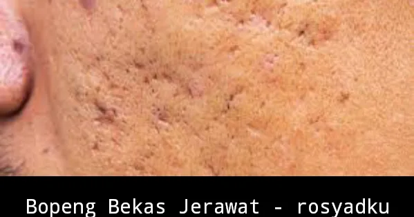 bopeng bekas jerawat