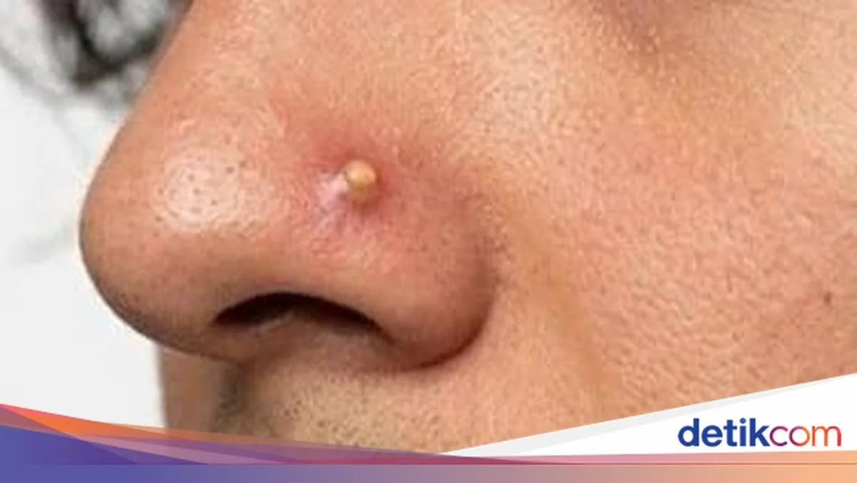 jerawat di hidung