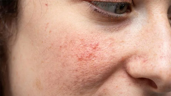 skin barrier rusak - Kesalahan Umum saat Mencoba Memperbaiki Skin Barrier