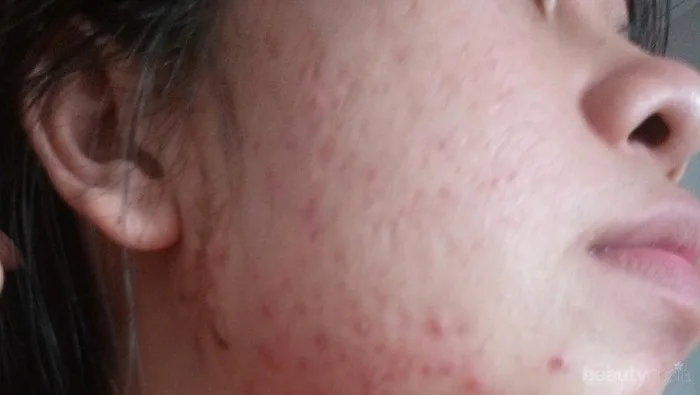 bekas jerawat kemerahan: Prinsip Dasar Skincare untuk Bekas Jerawat yang Efektif