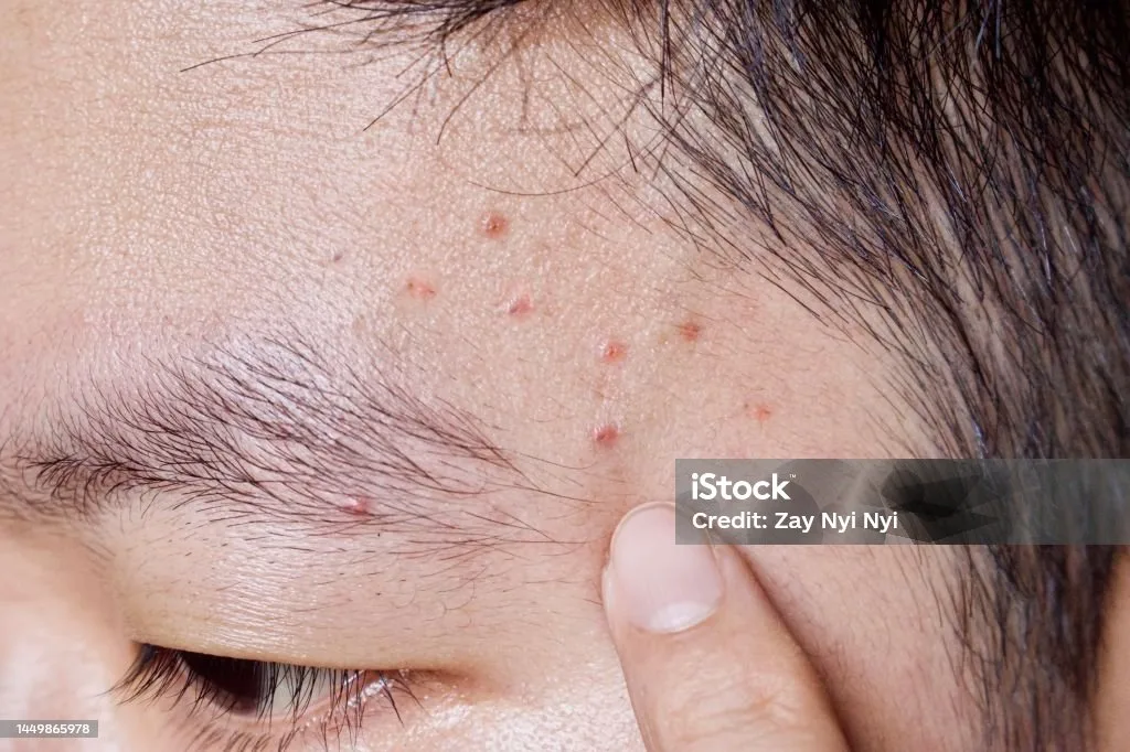 Pertanyaan yang Sering Diajukan Seputar Komedo Putih