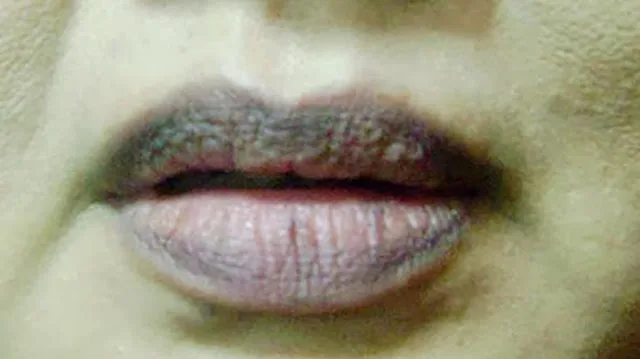cara merawat bibir hitam