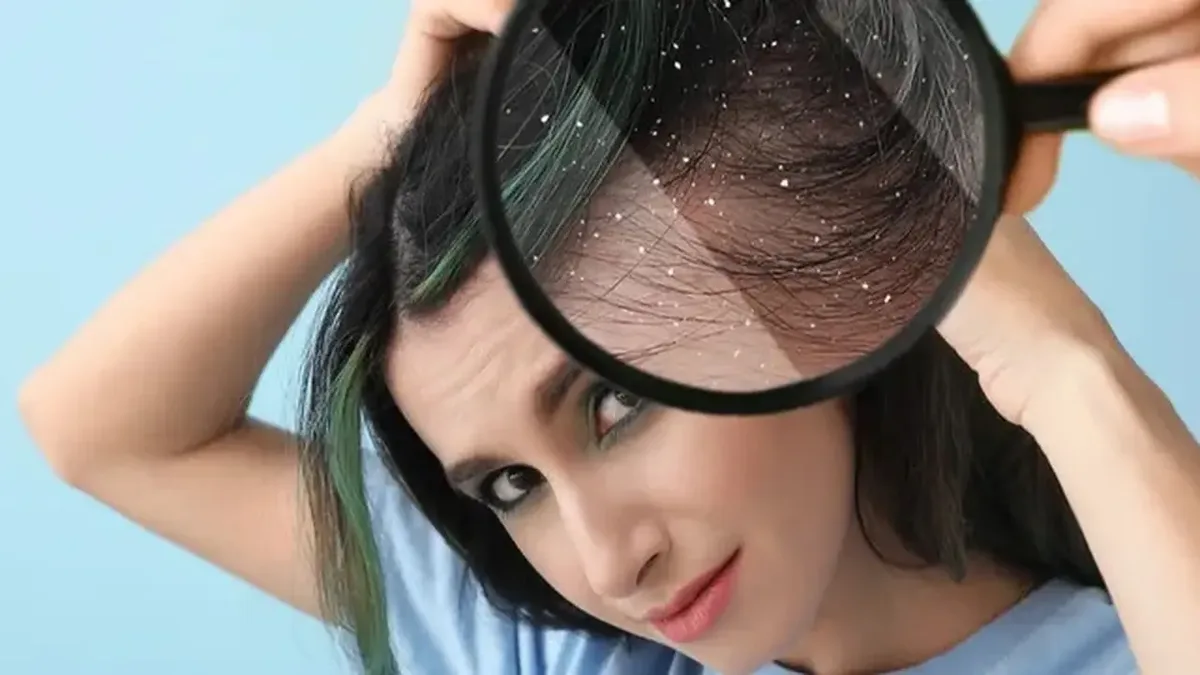 cara menghilangkan ketombe: Masker Alami Hilangkan Ketombe yang Bisa Anda Racik Sendiri