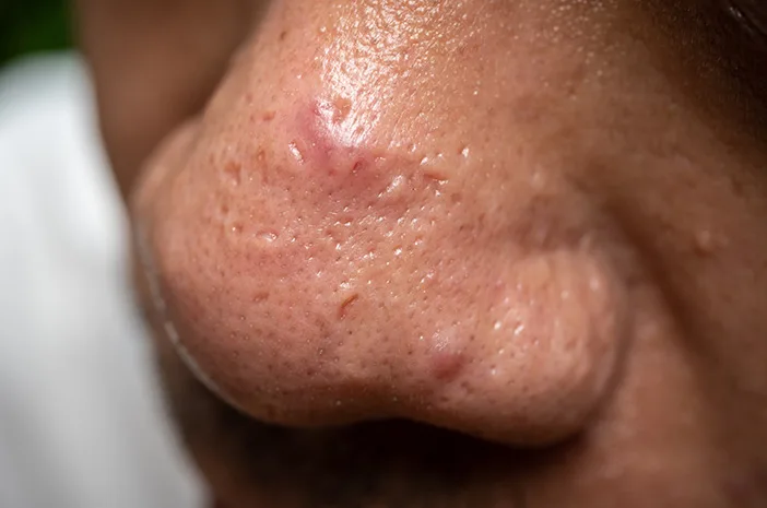 Penyebab Jerawat di Hidung yang Sering Diabaikan