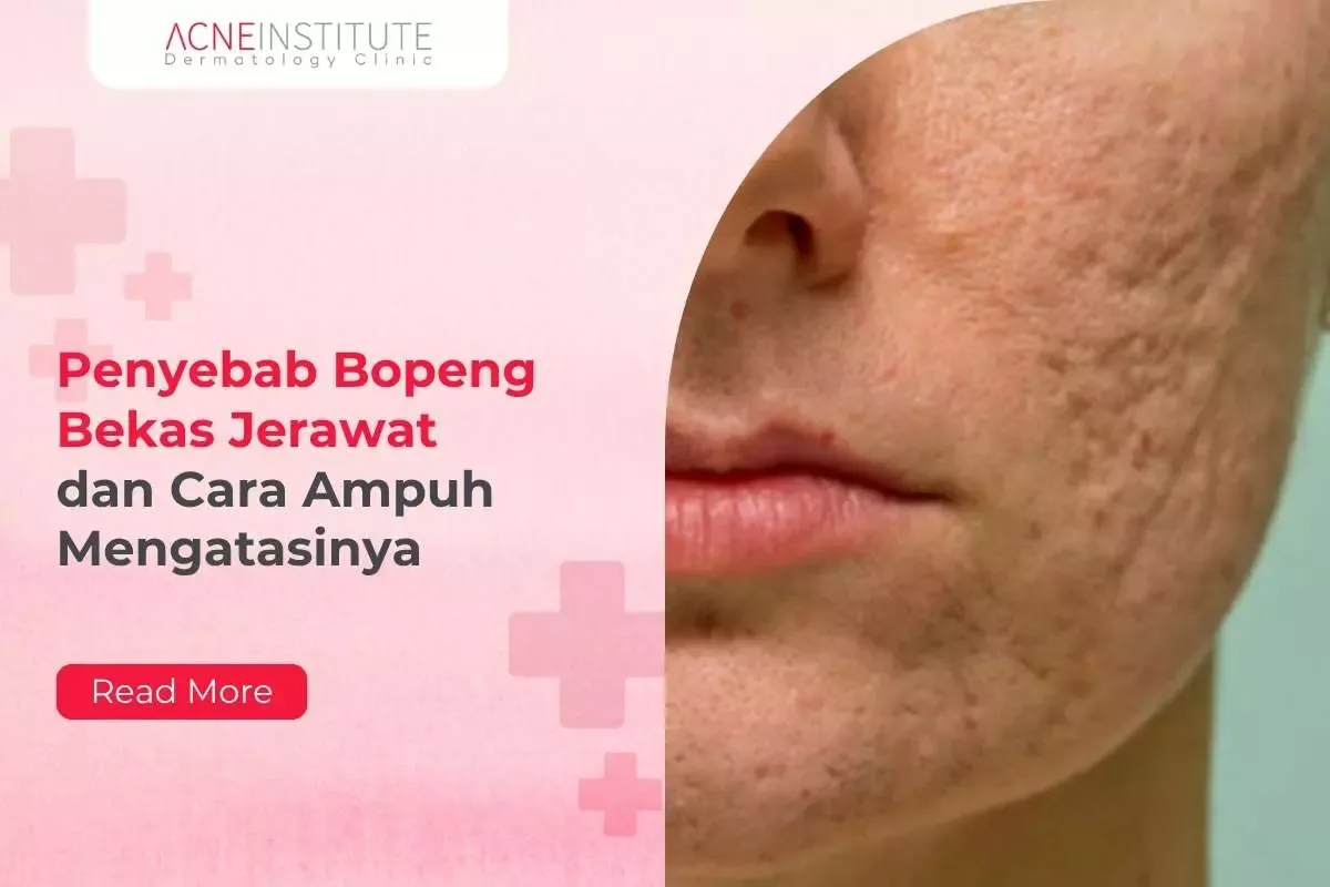 Pertanyaan Umum Seputar Bopeng Bekas Jerawat