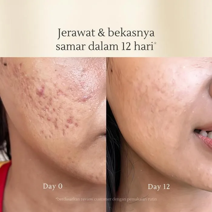 bekas jerawat kemerahan: Perlindungan Sinar Matahari sebagai Kunci Bekas Jerawat