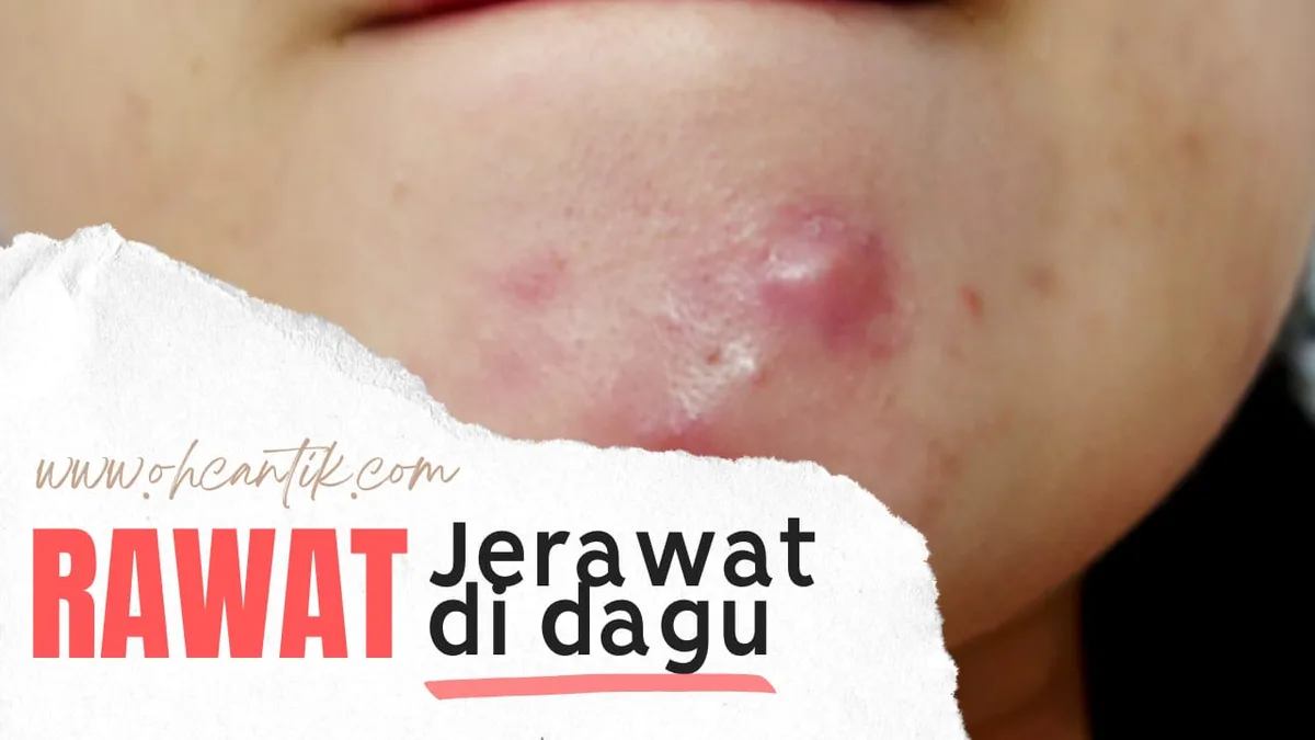 jerawat di dagu