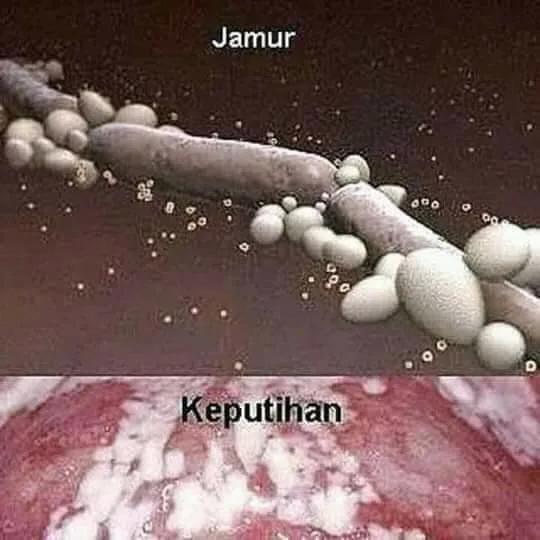 keputihan normal dan tidak normal - Tabel Perbandingan: Keputihan Normal vs Tidak Normal