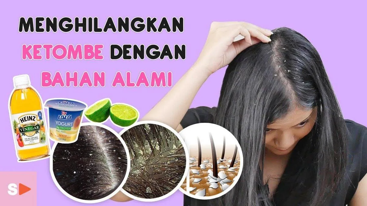 cara menghilangkan ketombe - Mengapa Ketombe Bisa Membandel? Memahami Penyebab Ketombe