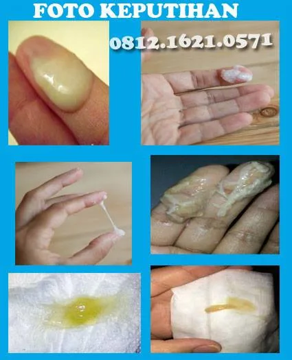 5 Cara Mengatasi Keputihan Gatal dan Berbau Secara Alami