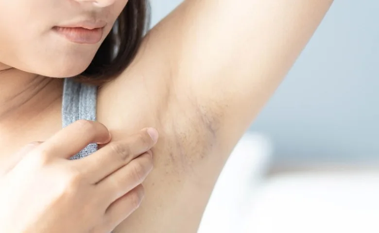 cara mencerahkan ketiak hitam
