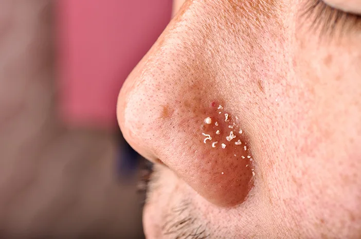 Memahami Komedo Putih di Dagu dan Hidung