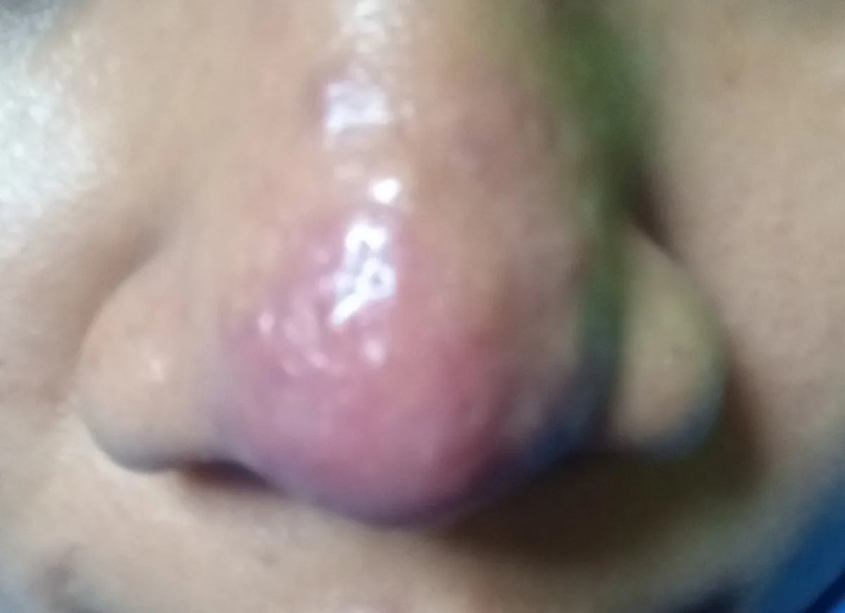 Perbandingan Pendekatan Perawatan Jerawat di Hidung